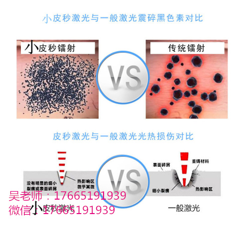 手持皮秒激光笔有效果吗皮秒激光祛斑皮秒激光